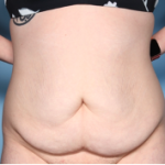 Body Lift Before & After Patient #34335